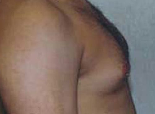 pre op gynecomastia