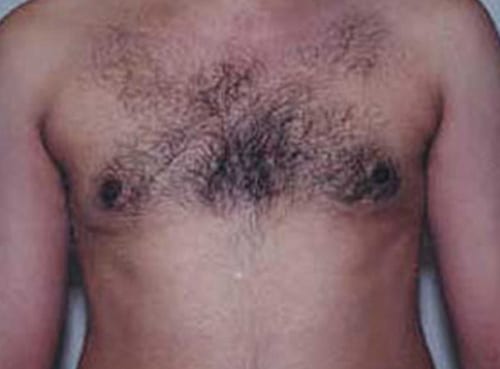 post op gynecomastia