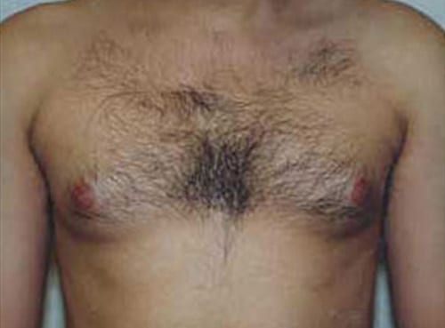 pre op gynecomastia