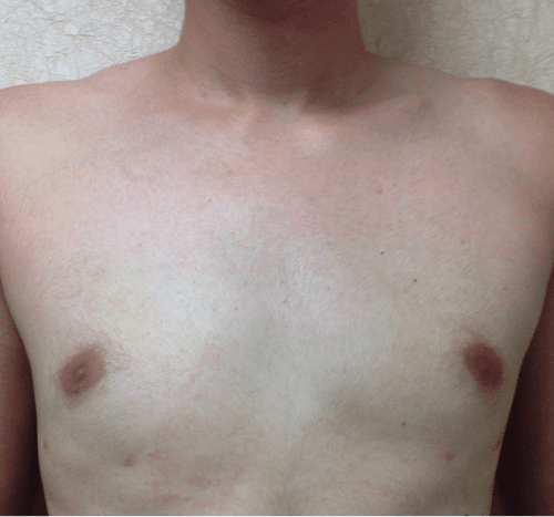 post op gynecomastia