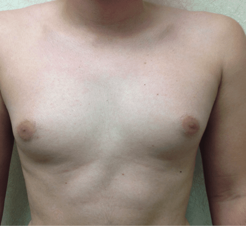 pre op gynecomastia