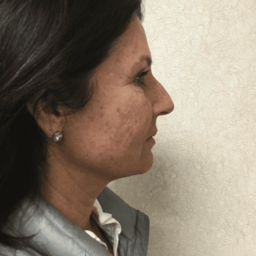 Infiniti Laser Treatment