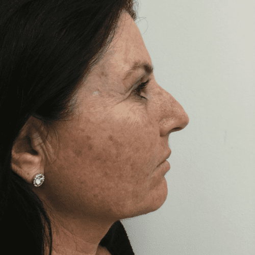 Before Infiniti Laser Treatment