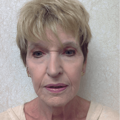 After Laser Treatment