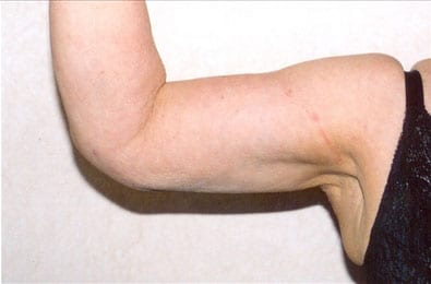 Liposuction-01 | After Liposuction 1