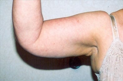 Liposuction-01 | Before Liposuction 1