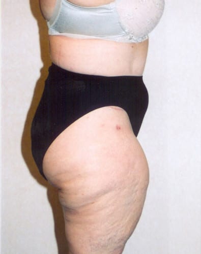 Liposuction-02 | Before Liposuction