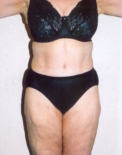 post op liposuction
