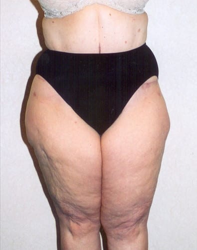 pre op liposuction