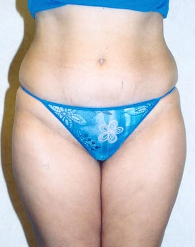 Liposuction-04 | Before Liposuction 2