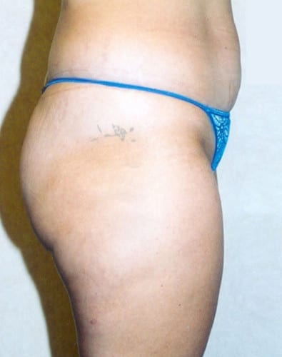 Liposuction-04 | Before Liposuction 3