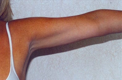Liposuction-06 | After Liposuction 1