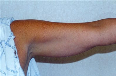 Liposuction-06 | Before Liposuction 1