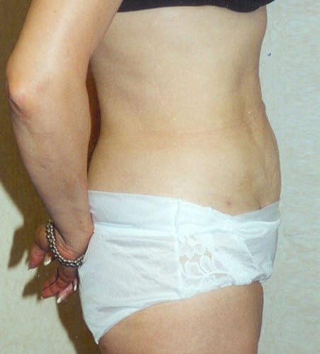 Liposuction-07 | After Liposuction