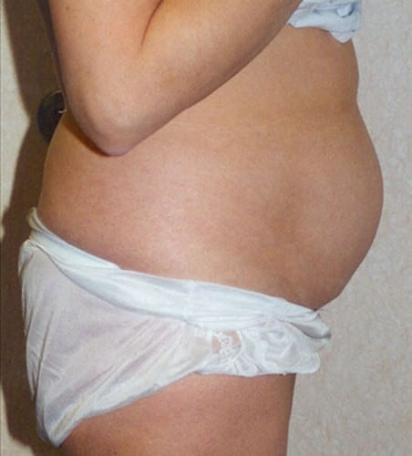 Liposuction-07 | Before Liposuction