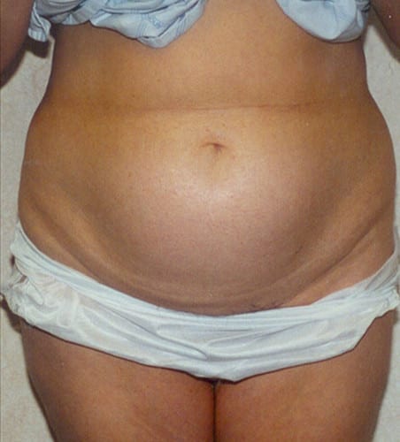 Liposuction-07 | Before Liposuction 2