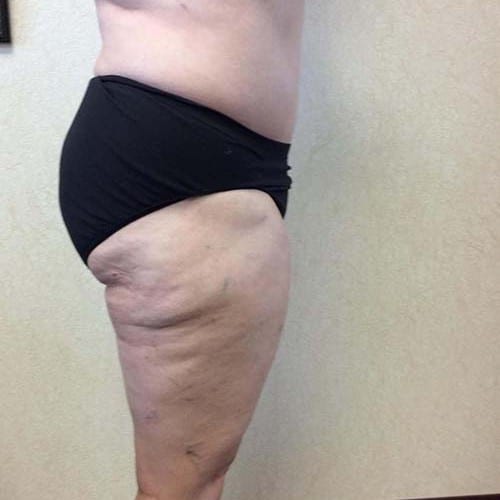 Liposuction-09 | After Liposuction