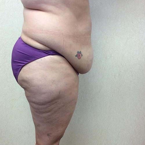 Liposuction-09 | Before Liposuction