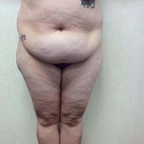 pre op liposuction
