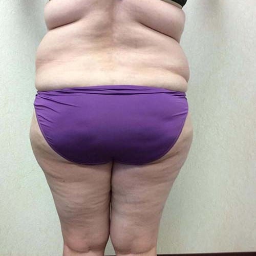 pre op liposuction