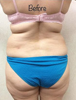 Liposuction-10 | Before Liposuction 1