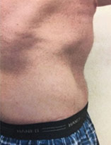 Liposuction-12 | Before Liposuction