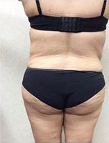 post op liposuction