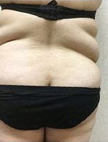pre op liposuction