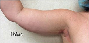 Liposuction-15 | Before Liposuction