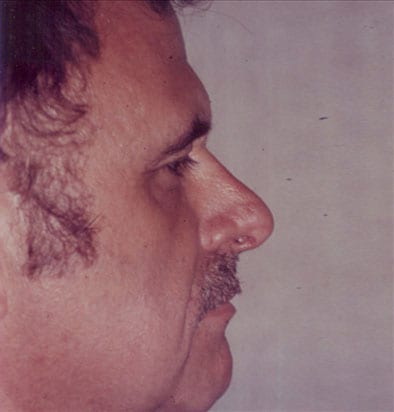 Male-Cosmetic-Surgery-01 | After Male Cosmetic Surgery