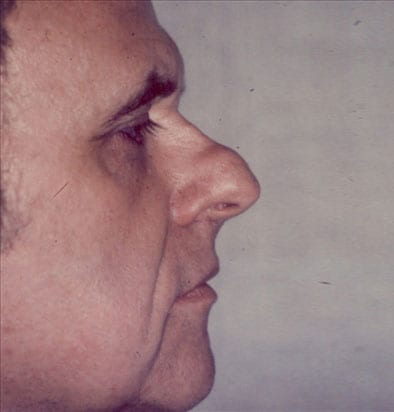Male-Cosmetic-Surgery-01 | Before Male Cosmetic Surgery