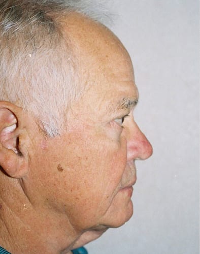 Male-Cosmetic-Surgery-02 | After Male Cosmetic Surgery