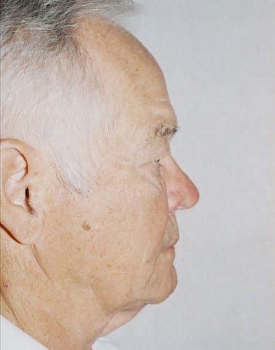 Male-Cosmetic-Surgery-02 | Before Male Cosmetic Surgery