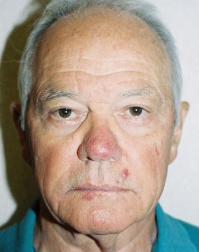 Male-Cosmetic-Surgery-02 | After Male Cosmetic Surgery 2