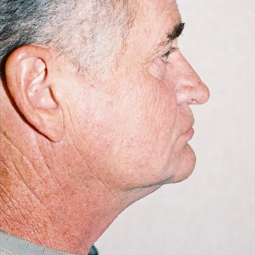 Male-Cosmetic-Surgery-06 | Before Male Cosmetic Surgery