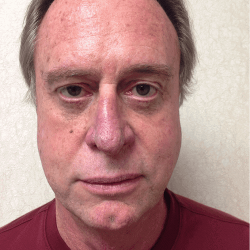 post op male eyelid surgery