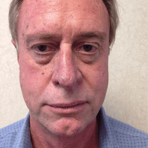 pre op male eyelid surgery