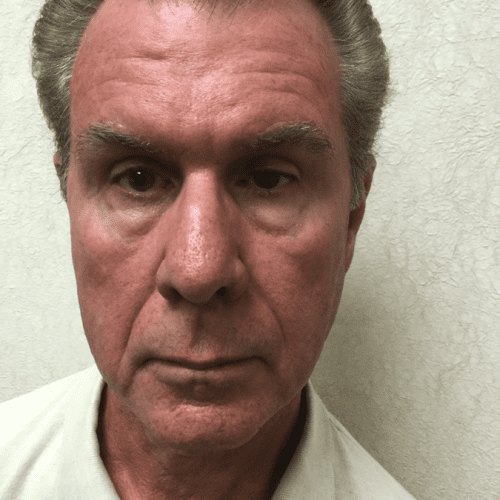 post op male eyelid surgery