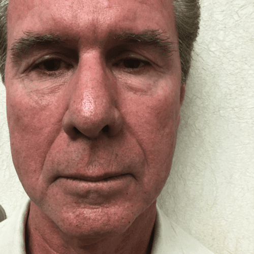 pre op male eyelid surgery