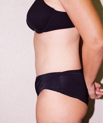 Mommy-Makeover-01 | After Body