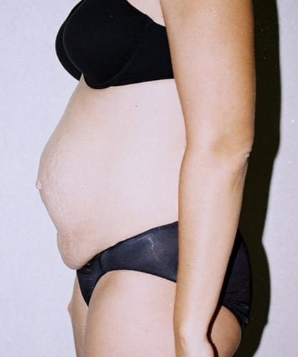 Mommy-Makeover-01 | Before Body