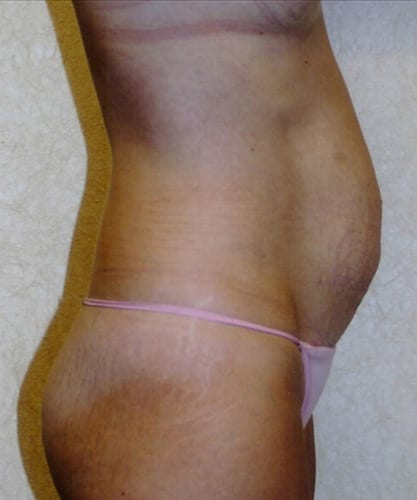 Mommy-Makeover-02 | Before Body
