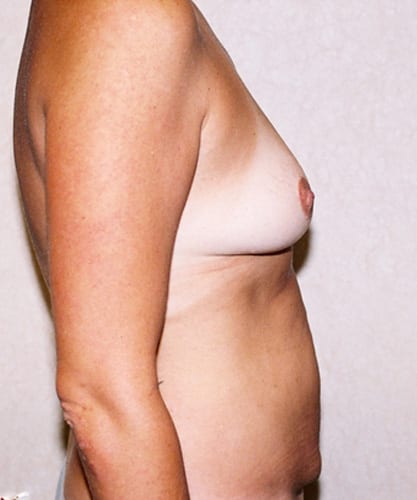 Mommy-Makeover-03 | Before Body