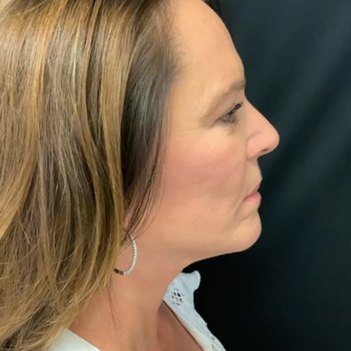 After Facelift and Neck Lift