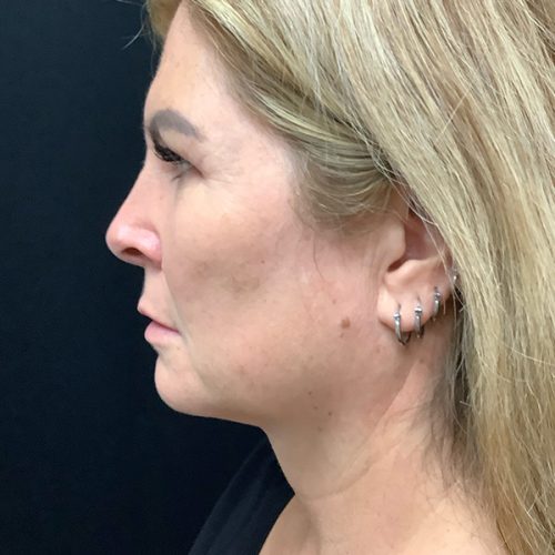 Neck-Liposuction | After Neck Liposuction