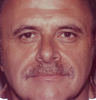 Rhinoplasty-01 | After Rhinoplasty 2