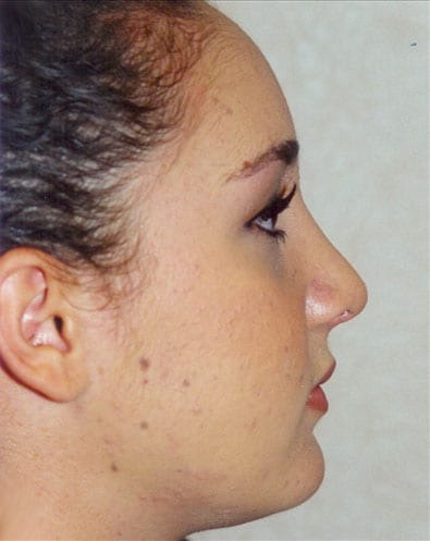 Rhinoplasty-02 | After Rhinoplasty 1