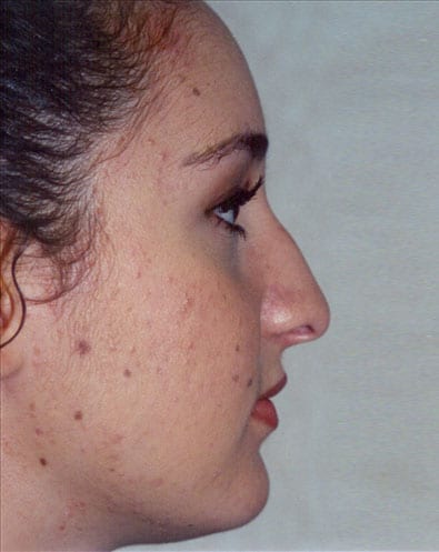 Rhinoplasty-02 | Before Rhinoplasty 1