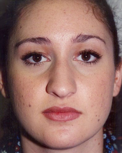 Rhinoplasty-02 | Before Rhinoplasty 2