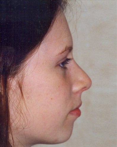Rhinoplasty-03 | After Face